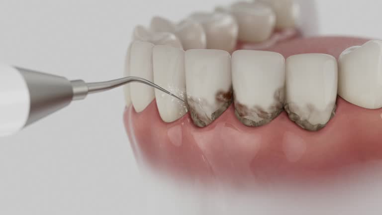 Reliable Tooth Extraction contractor in Springville, UT by Smile Center Dentistry